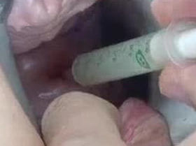 Insertion of Semen with Syringe into Uterus